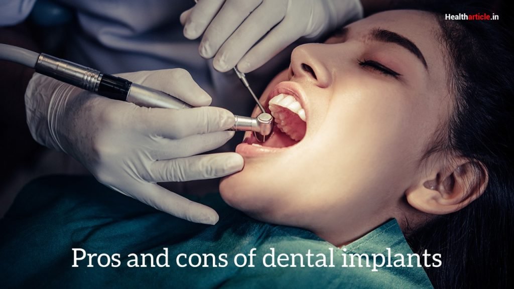 Full mouth implants